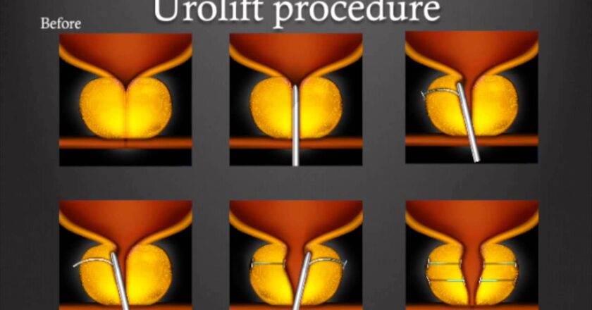 Asian Institute of Nephrology and Urology (AINU, Chennai) introduces ‘UroLift’